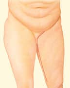 08 thigh lift 02