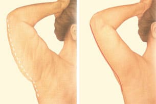 arm lift back arm incision