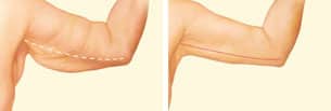 arm lift inner arm incision