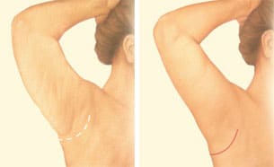 arm lift minimal incision