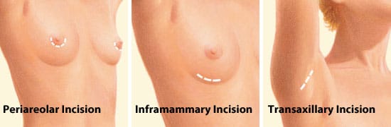 breast augmentation incisions (1)