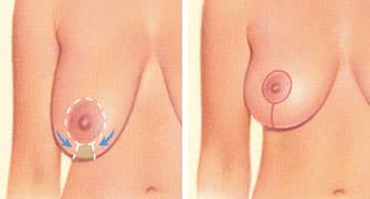 breast lift incision areola breast crease