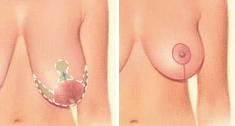 breast lift incision areola horizontal