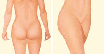 liposuction after buttock thighs stomach