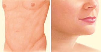 liposuction after stomach breasts chin