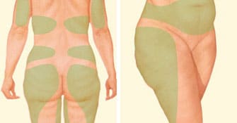 liposuction before back thighs stomach
