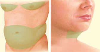 liposuction before stomach breasts chin