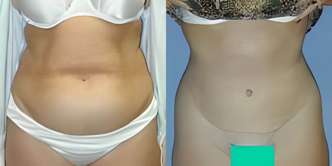 Before and After Image of Top Tummy Tuck Surgeon Cleveland