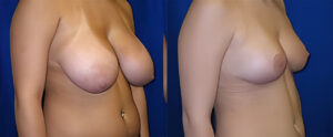 Before and After Image of Breast Reduction Surgeon Cleveland