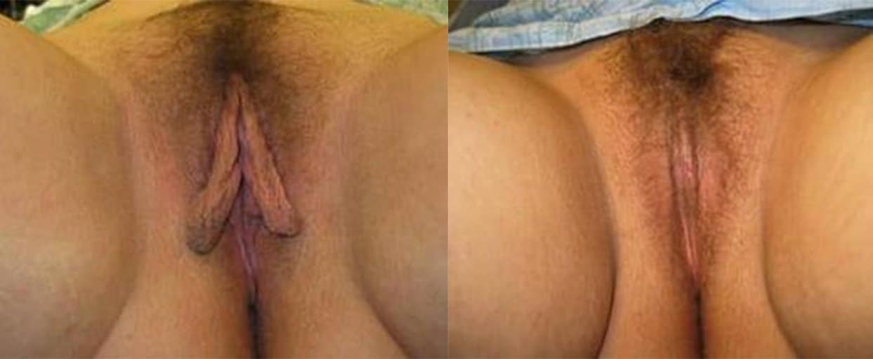 Before and After Image of Labiaplasty Cleveland