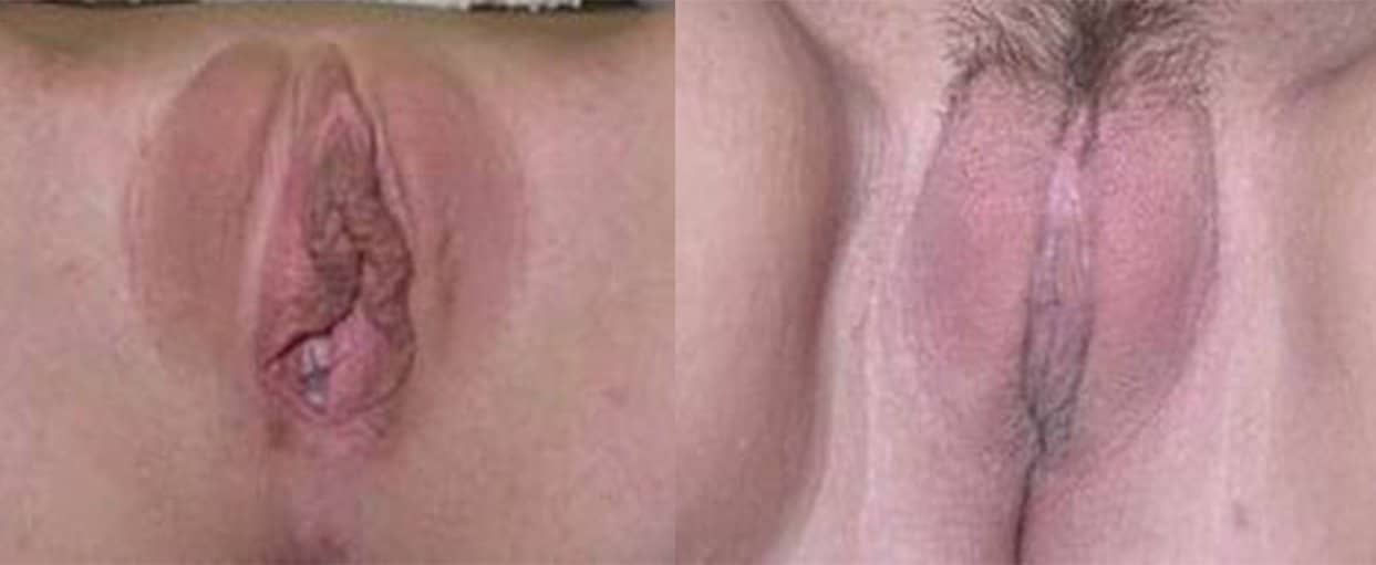 labiaplasty 2 edited
