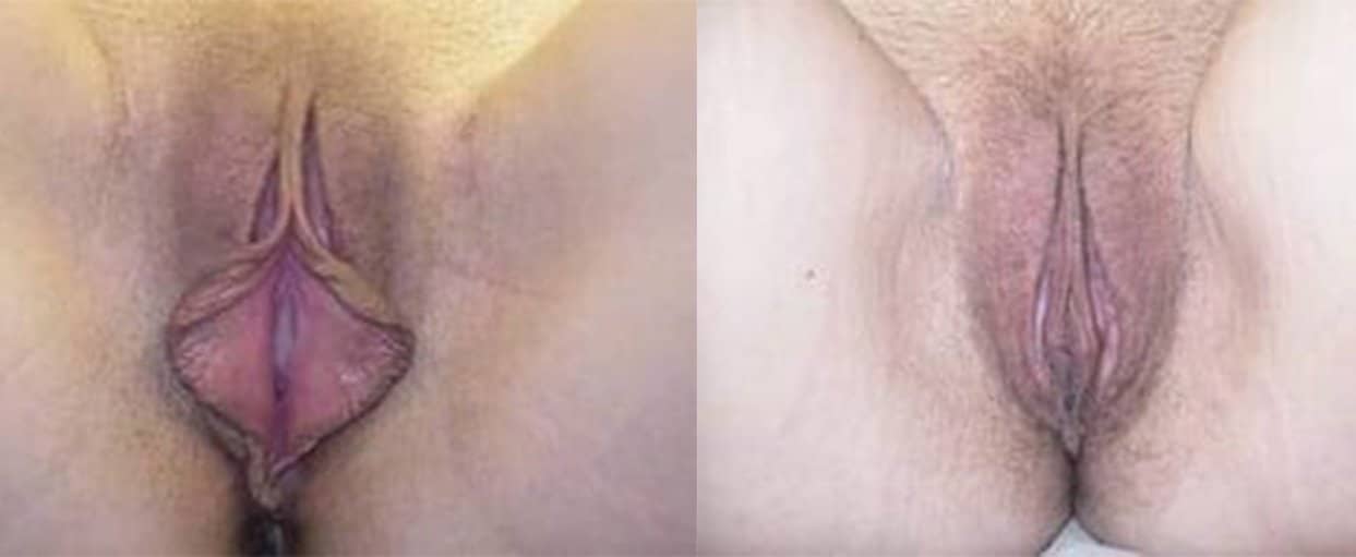 labiaplasty 3 edited