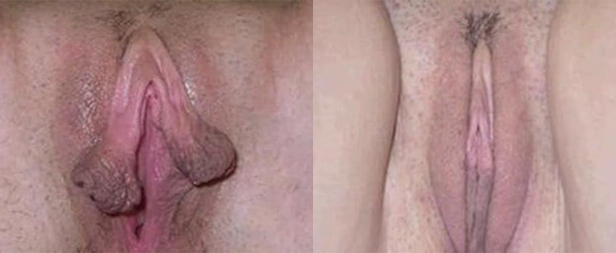 labiaplasty 4 edited