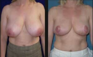 breast reduction case1