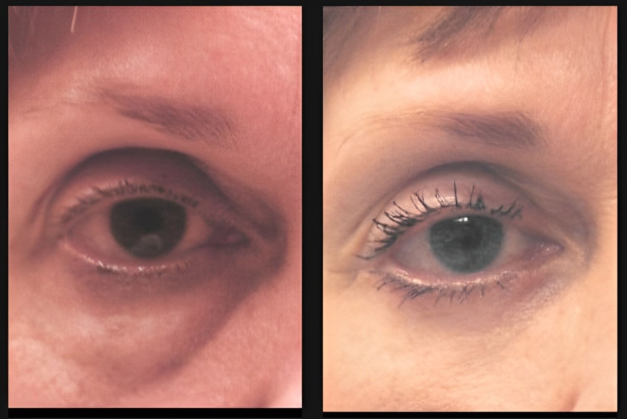 case1 blepharoplasty scaled