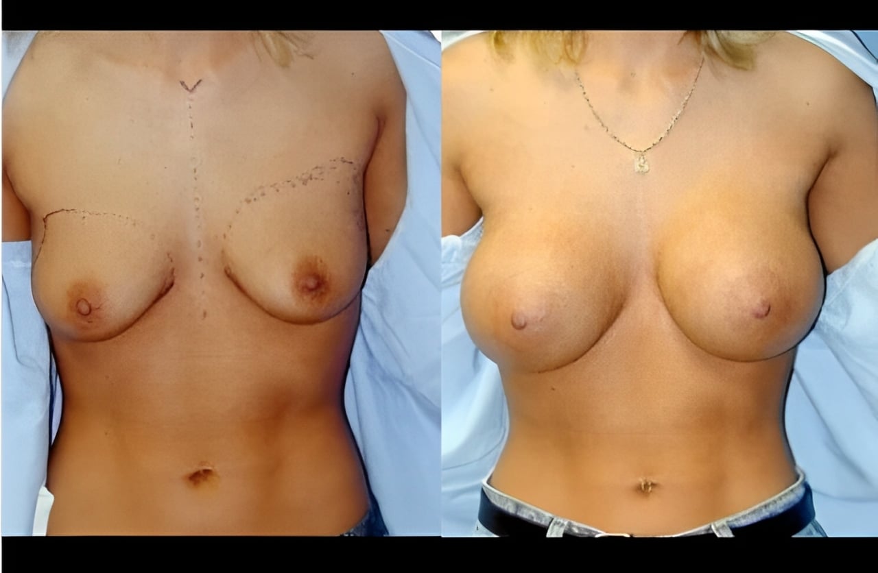 case2 breast aug