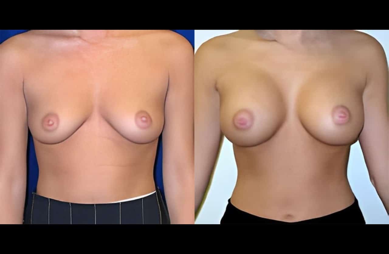 case3 breast aug