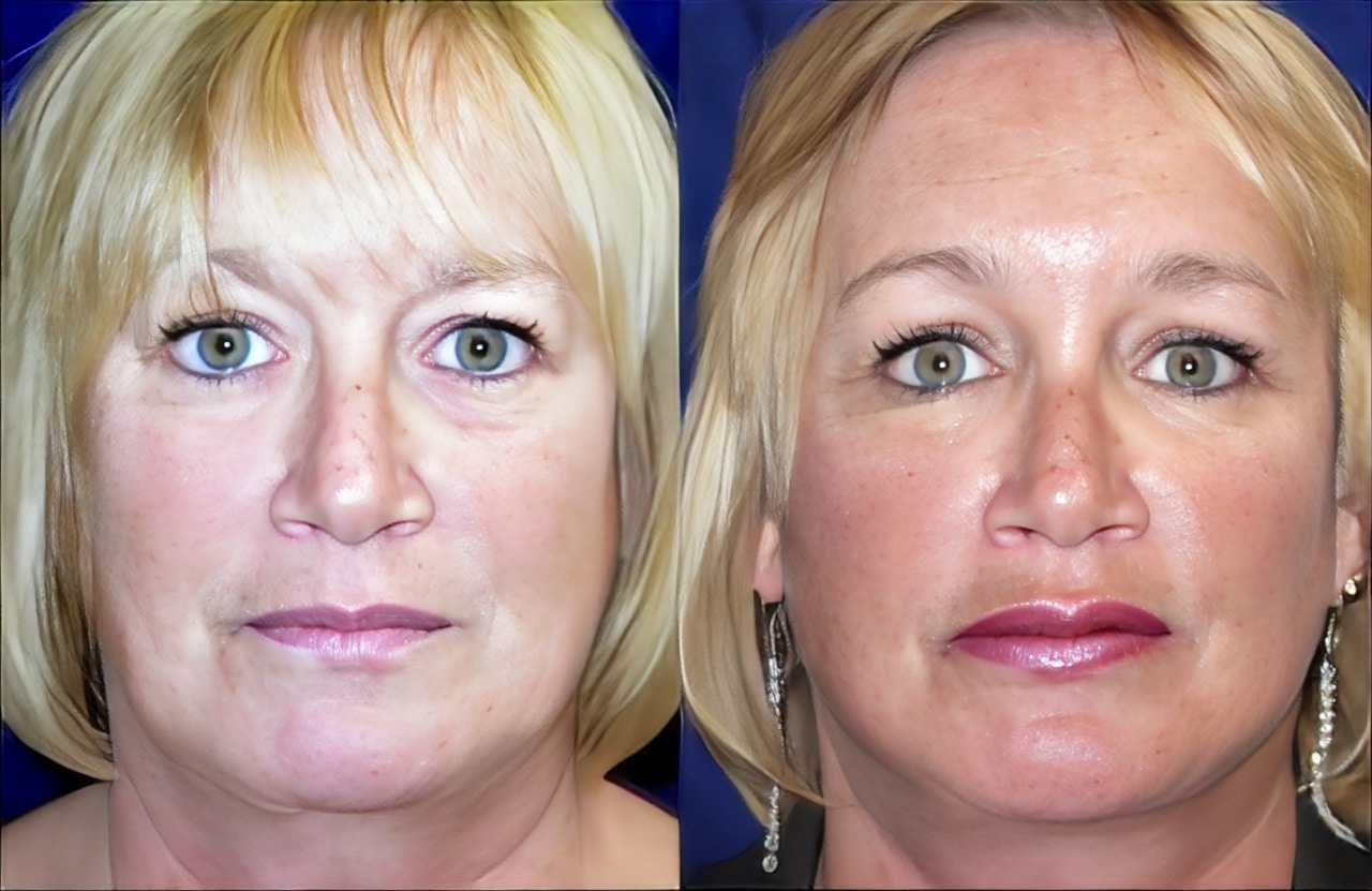facelift case3