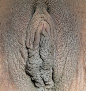 Before Image: Labia Majora Fat Grafting, Labiaplasty and Clitoral Hood Reduction