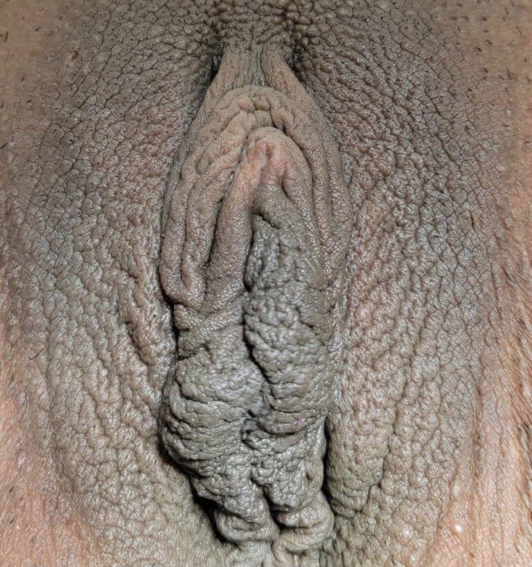 Before Image: Labia Majora Fat Grafting, Labiaplasty and Clitoral Hood Reduction - front