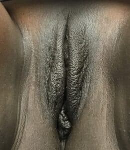 Before Image: Labia Majora Fat Grafting and Small Right Labiaplasty