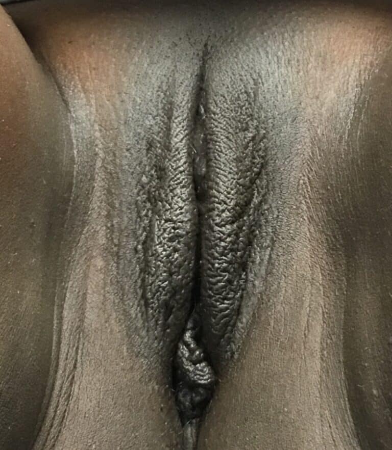 Before Image: Labia Majora Fat Grafting and Small Right Labiaplasty - front