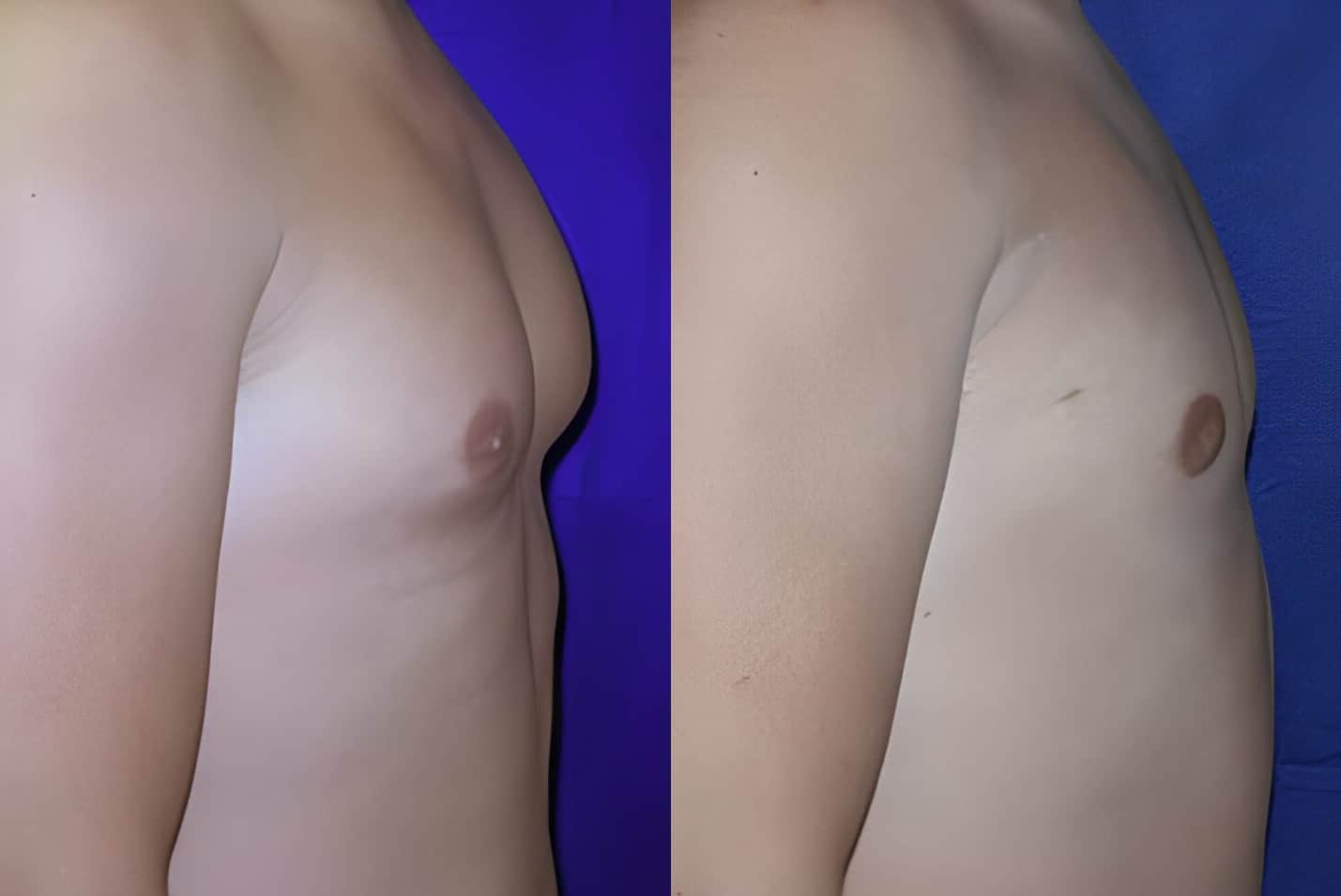 gynecomastia ba