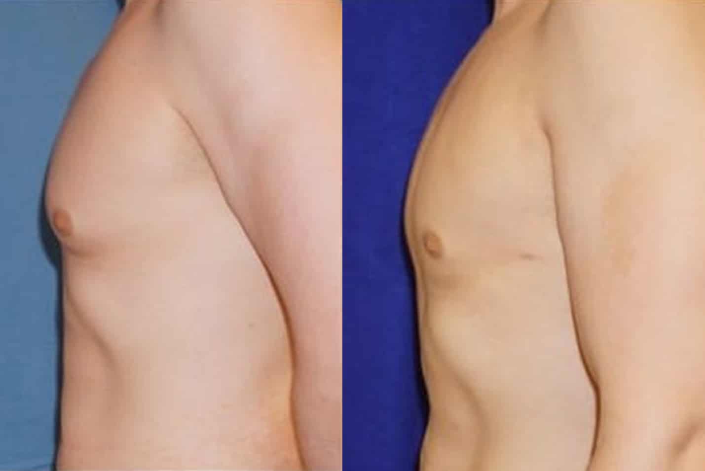 gynecomastia ba2