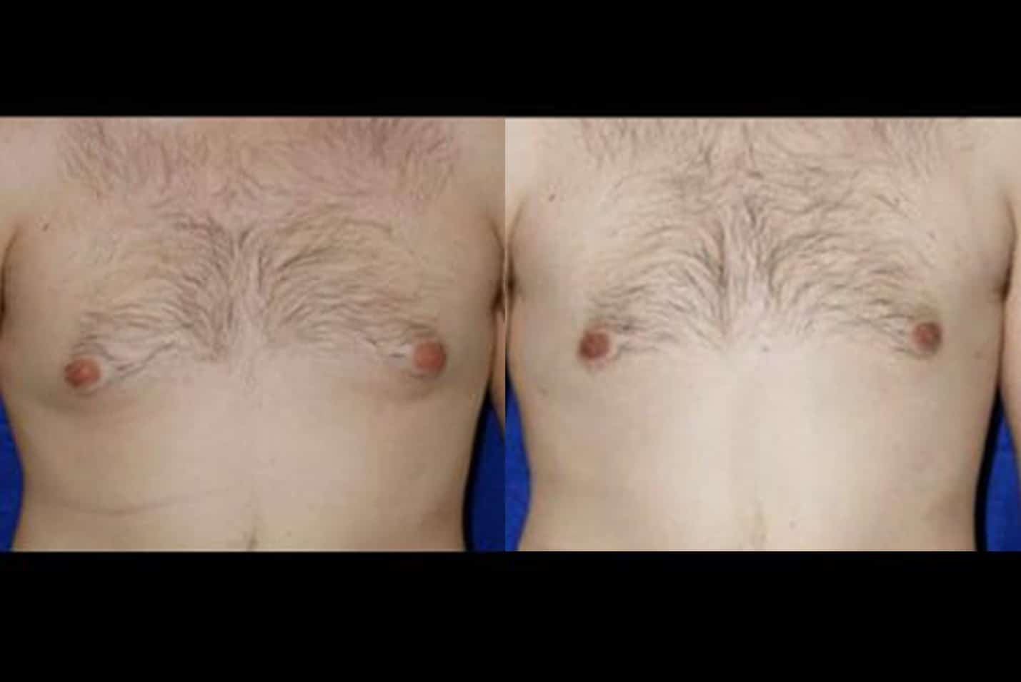 gynecomastia ba3