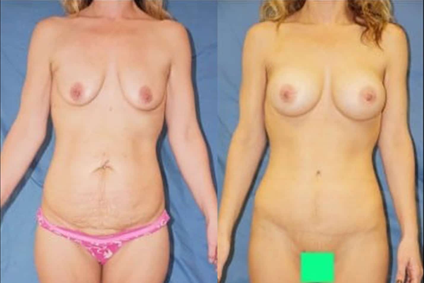 mommy makeover ba1 2