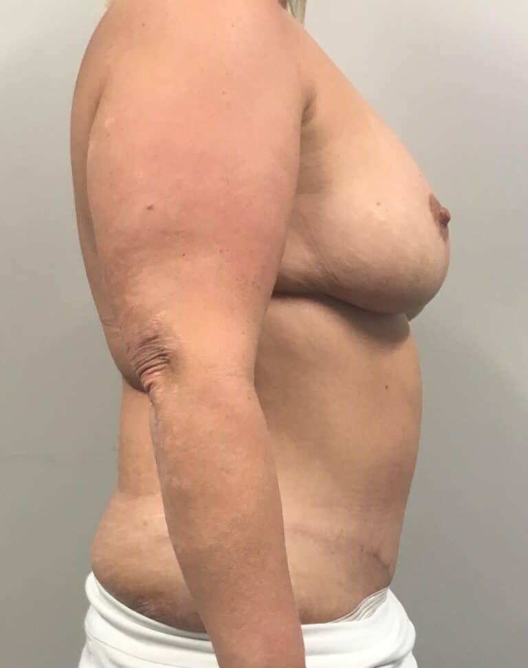 After Image: Mommy Makeover with Breast Lift and Tummy Tuck and Liposuction 360 - right-side