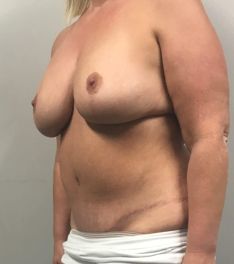 After Image: Mommy Makeover with Breast Lift and Tummy Tuck and Liposuction 360 - left-front-oblique