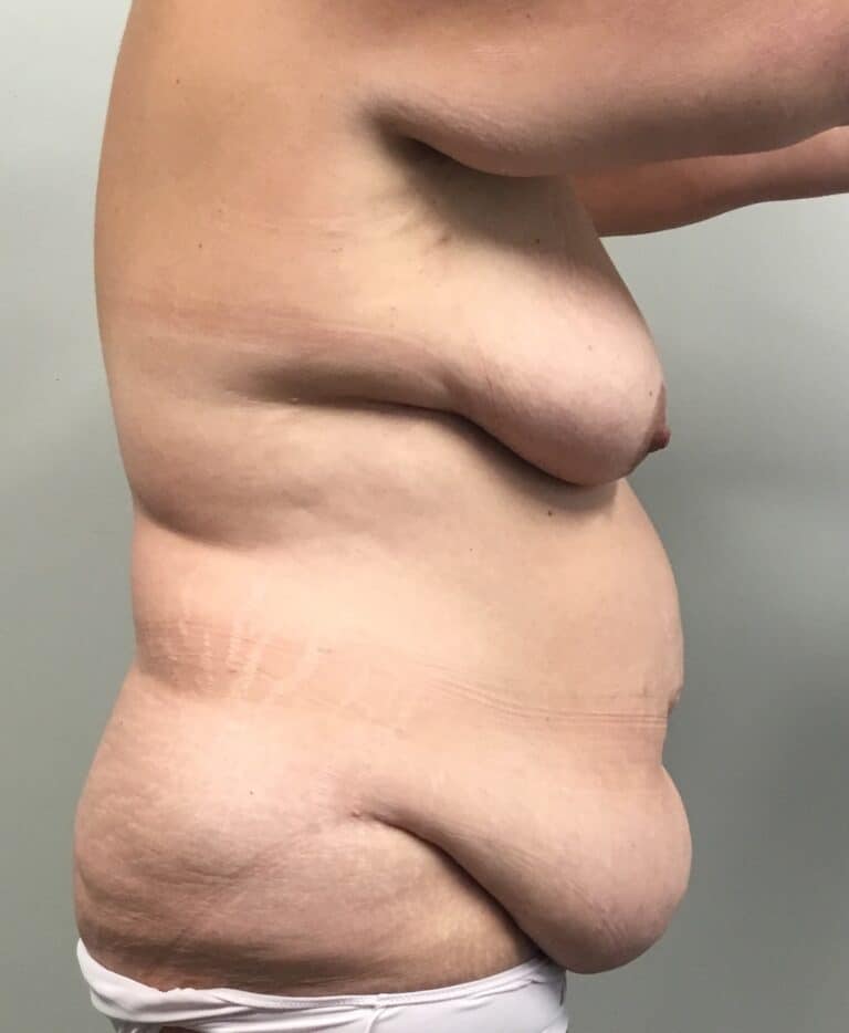 Before Image: Mommy Makeover with Breast Lift and Tummy Tuck and Liposuction 360 - right-side