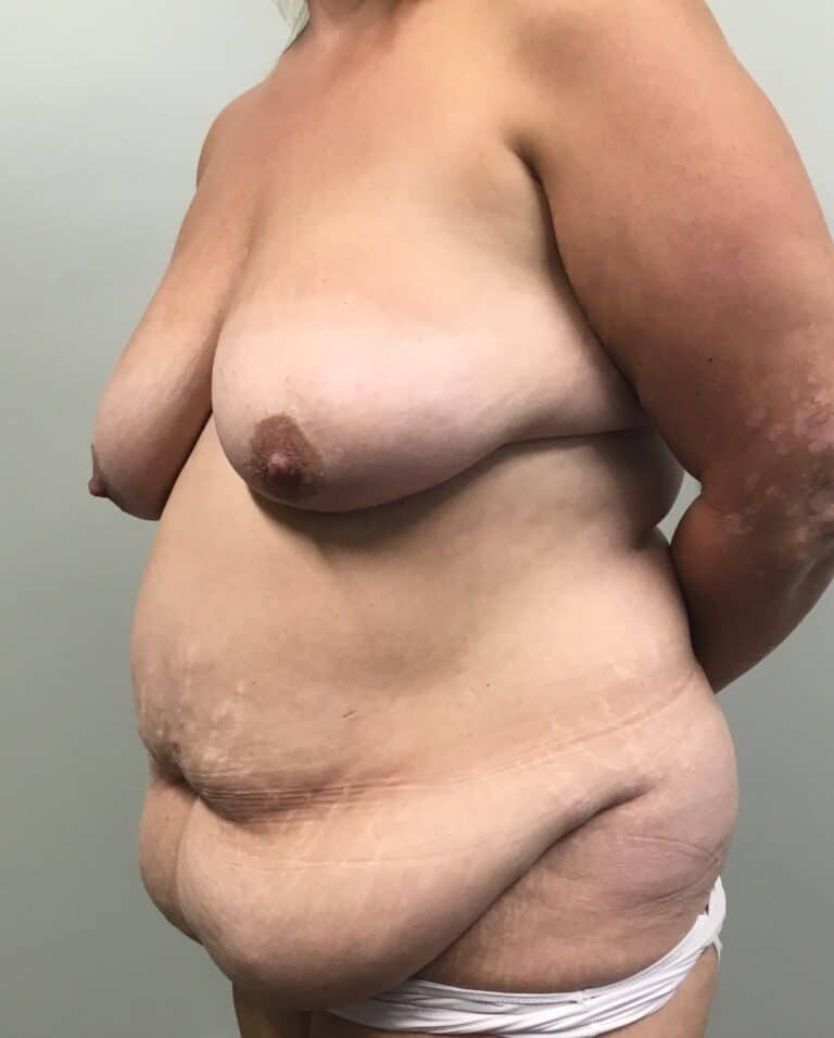 Before Image: Mommy Makeover with Breast Lift and Tummy Tuck and Liposuction 360 - left-front-oblique