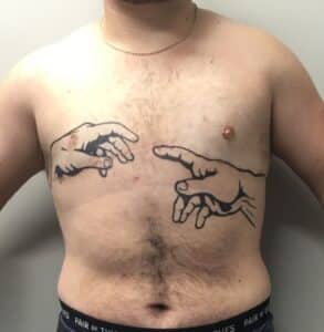 After Image: FtM Top Surgery Revision with Liposuction of Dog Ears