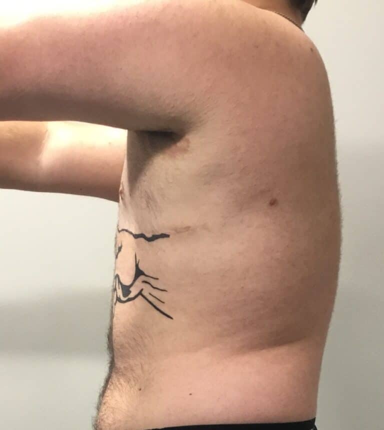 After Image: FtM Top Surgery Revision with Liposuction of Dog Ears - left-side