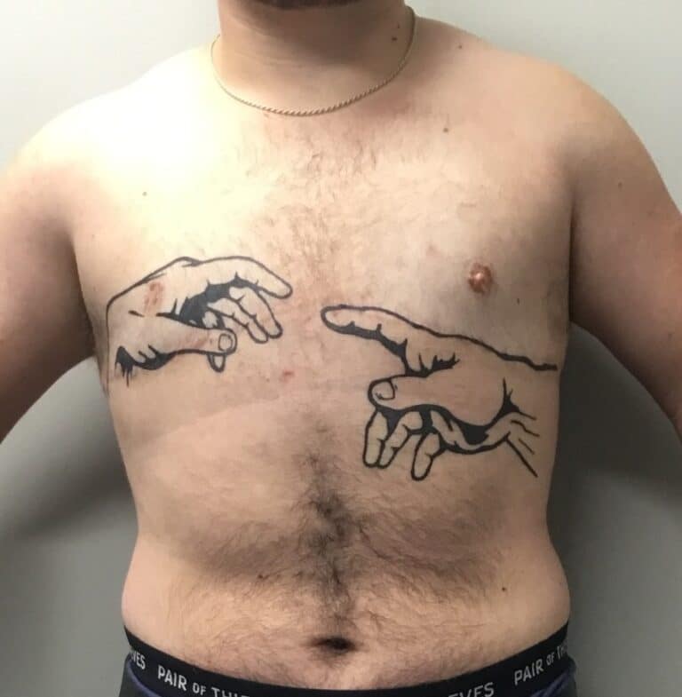 After Image: FtM Top Surgery Revision with Liposuction of Dog Ears - front
