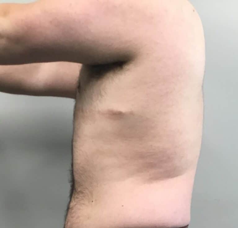 Before Image: FtM Top Surgery Revision with Liposuction of Dog Ears - left-side