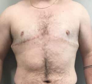 Before Image: FtM Top Surgery Revision with Liposuction of Dog Ears