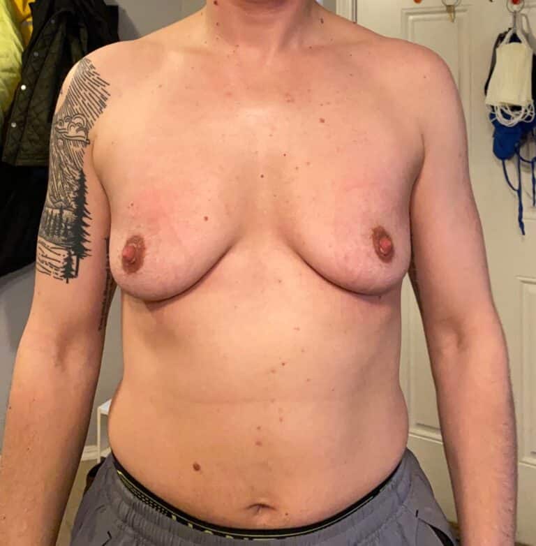 Before Image: FtM Double Incision Top Surgery with Nipple Grafts - front