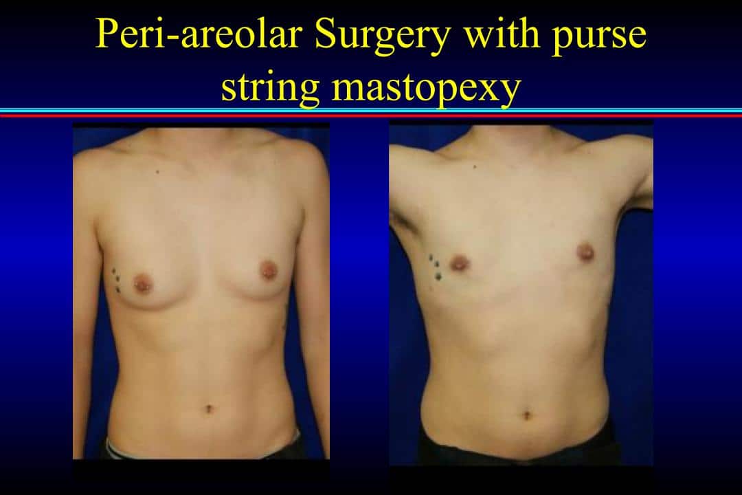 Gender Affirmation topsurgery