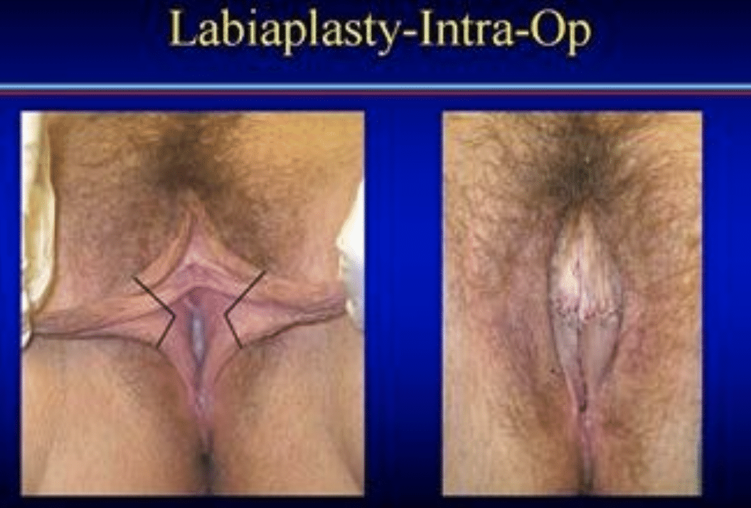 Labiaplasty Intra op