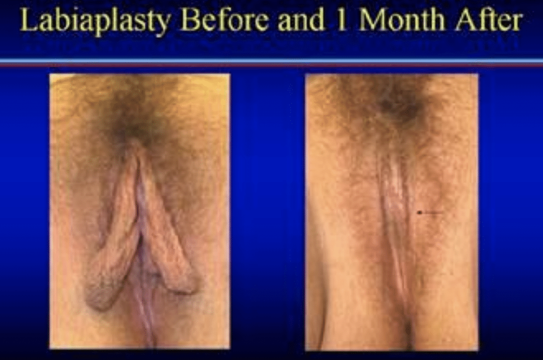 Labiaplasty before and after