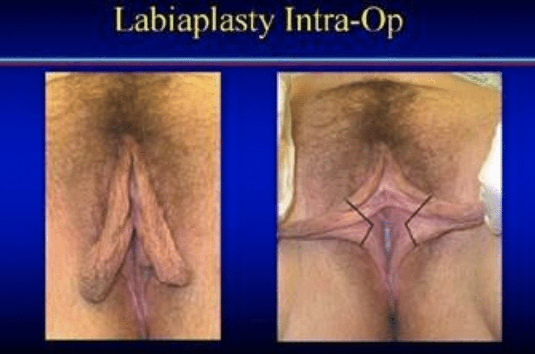 Labiaplasty pre op