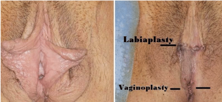 Simultaneous Labiaplasty and Vaginoplasty