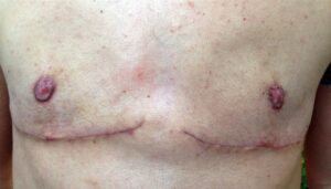 After Image: Top Surgery Revision with Conversion to Double Incision and Nipple Grafts