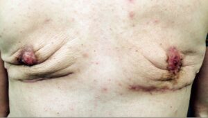 Before Image: Top Surgery Revision with Conversion to Double Incision and Nipple Grafts