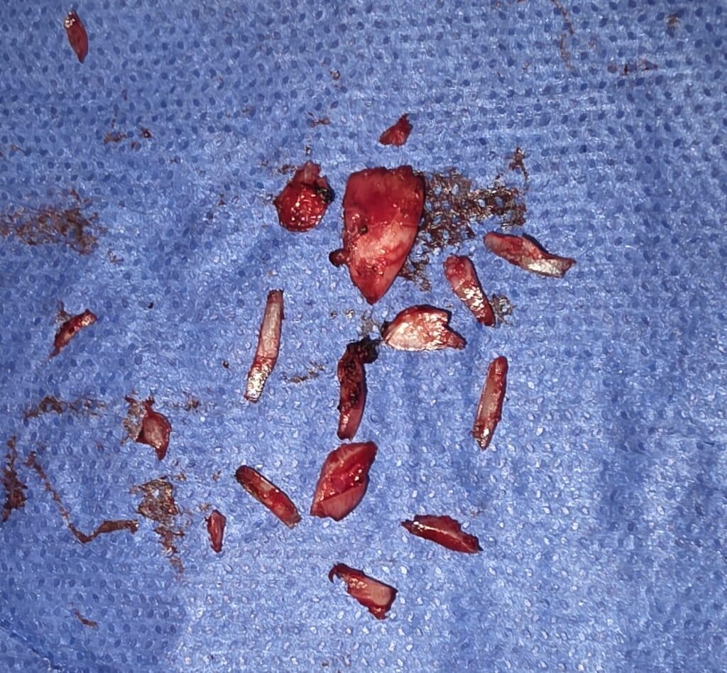 Tracheal Shave Cartilage