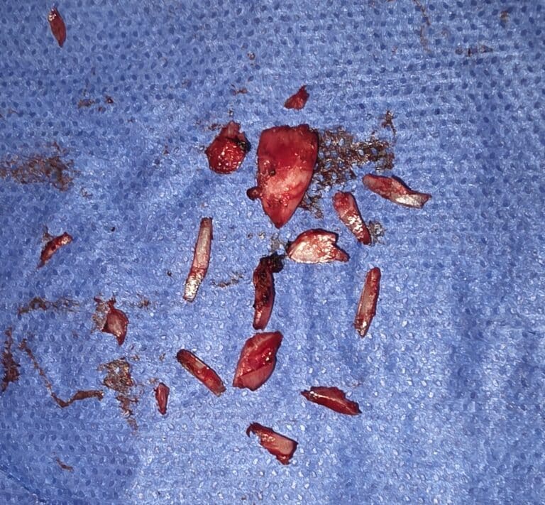 Tracheal Shave Cartilage