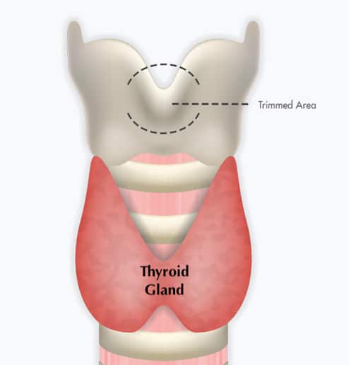 Tracheal Shave